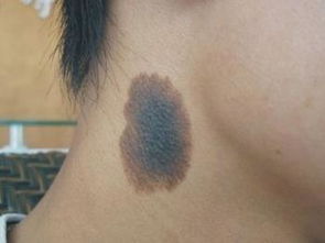 不容简单行痣——别轻巧简单远行