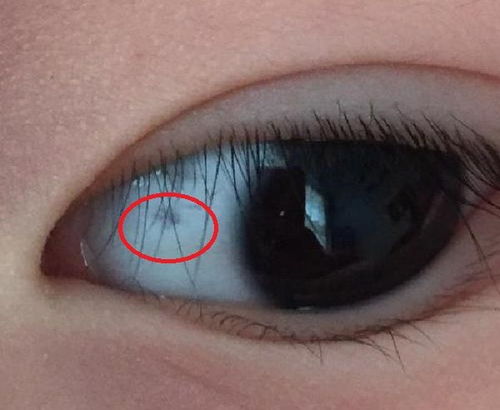 啥叫“眼白痣”？先说清楚