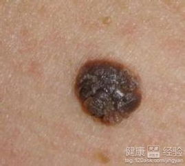 先说这痣到底是个啥子